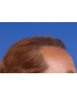 After Hair Transplant&nbsp;2 Sessions (Areas)